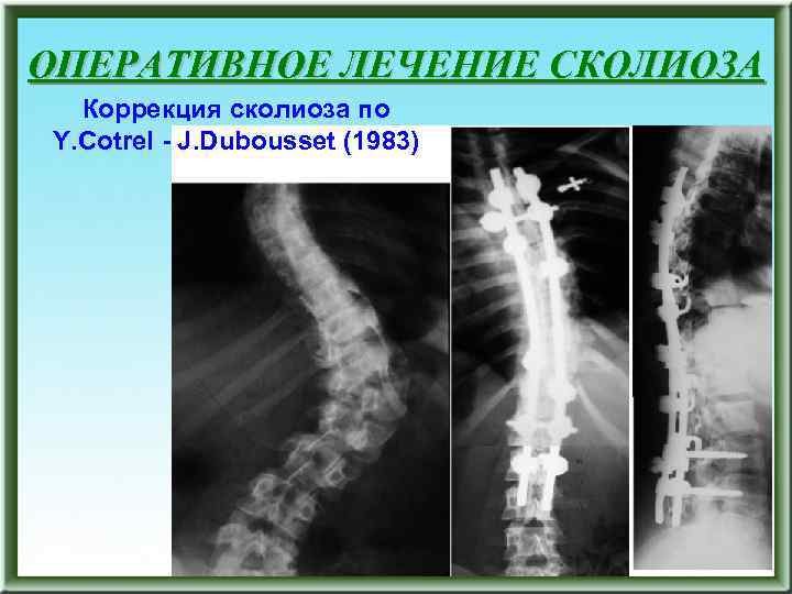 ОПЕРАТИВНОЕ ЛЕЧЕНИЕ СКОЛИОЗА Коррекция сколиоза по Y. Cotrel - J. Dubousset (1983) 