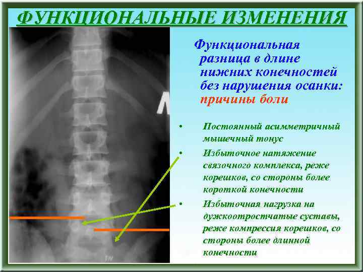 ФУНКЦИОНАЛЬНЫЕ ИЗМЕНЕНИЯ Функциональная разница в длине нижних конечностей без нарушения осанки: причины боли •