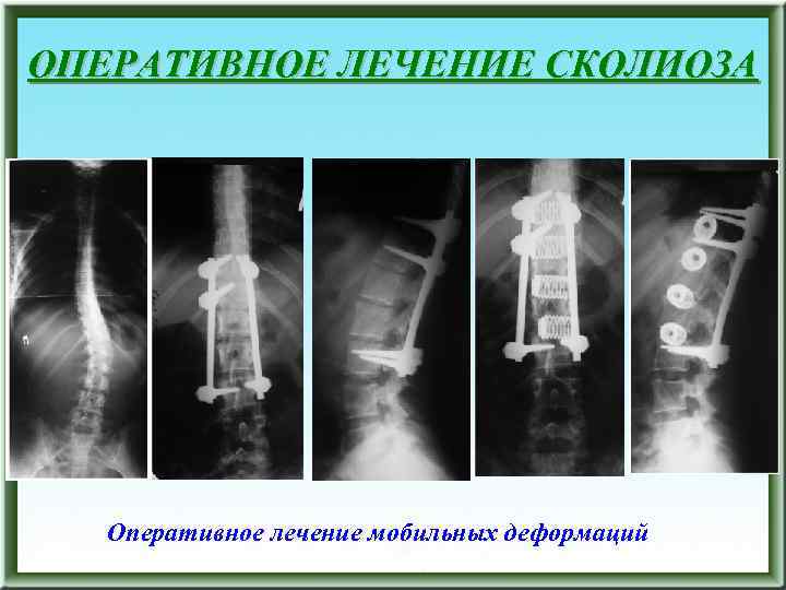 ОПЕРАТИВНОЕ ЛЕЧЕНИЕ СКОЛИОЗА Оперативное лечение мобильных деформаций 