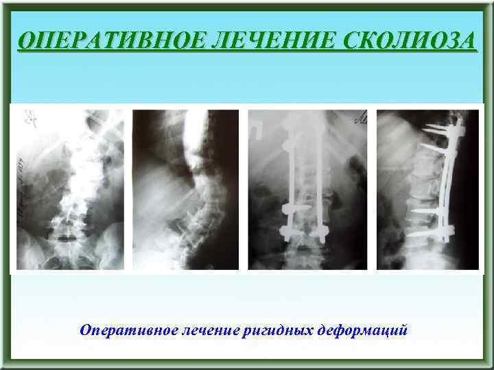 ОПЕРАТИВНОЕ ЛЕЧЕНИЕ СКОЛИОЗА Оперативное лечение ригидных деформаций 