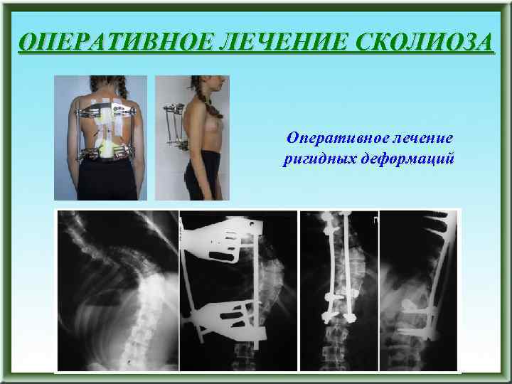 ОПЕРАТИВНОЕ ЛЕЧЕНИЕ СКОЛИОЗА Оперативное лечение ригидных деформаций 