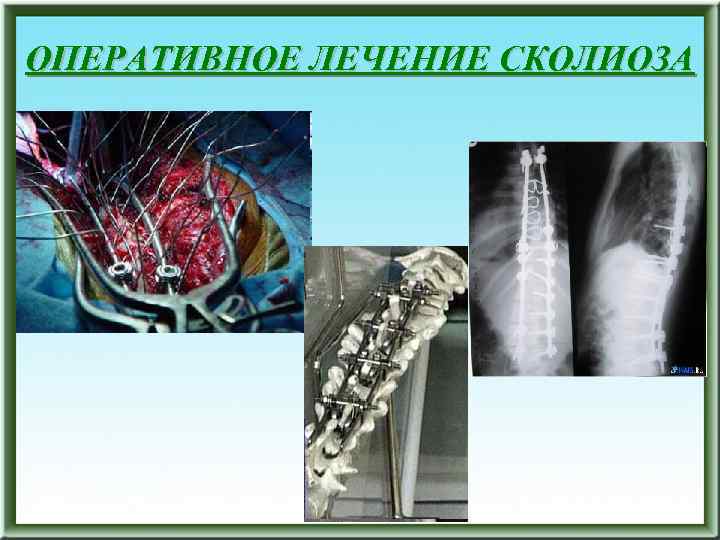 ОПЕРАТИВНОЕ ЛЕЧЕНИЕ СКОЛИОЗА 