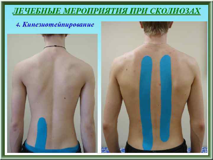 ЛЕЧЕБНЫЕ МЕРОПРИЯТИЯ ПРИ СКОЛИОЗАХ 4. Кинезиотейпирование 