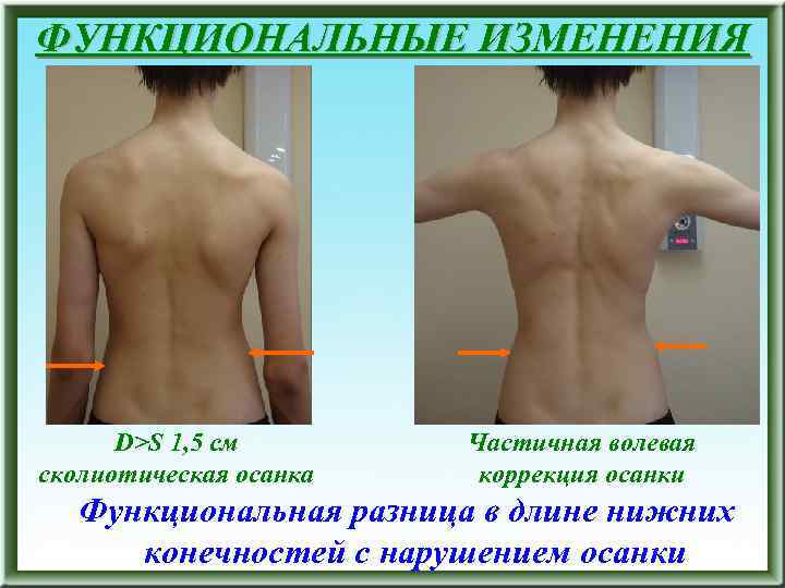 ФУНКЦИОНАЛЬНЫЕ ИЗМЕНЕНИЯ D>S 1, 5 см сколиотическая осанка Частичная волевая коррекция осанки Функциональная разница