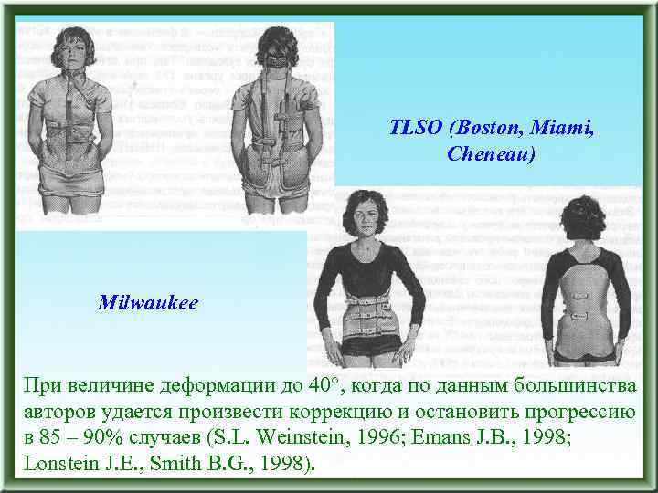 TLSO (Boston, Miami, Cheneau) Milwaukee При величине деформации до 40 , когда по данным