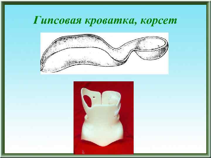 Гипсовая кроватка, корсет 