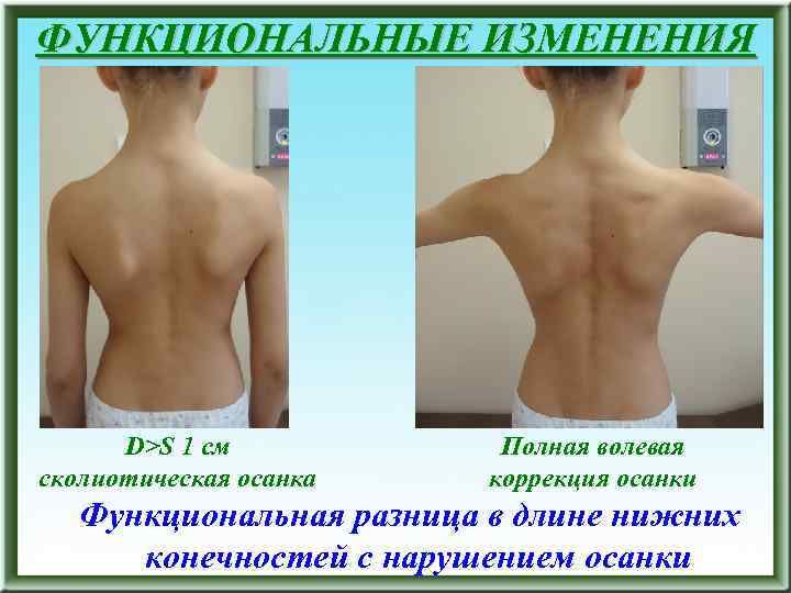 ФУНКЦИОНАЛЬНЫЕ ИЗМЕНЕНИЯ D>S 1 см сколиотическая осанка Полная волевая коррекция осанки Функциональная разница в
