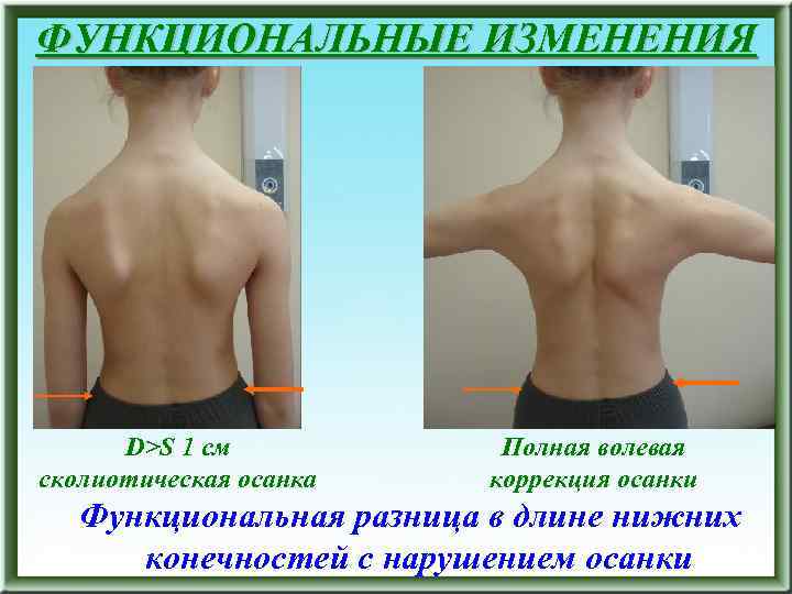ФУНКЦИОНАЛЬНЫЕ ИЗМЕНЕНИЯ D>S 1 см сколиотическая осанка Полная волевая коррекция осанки Функциональная разница в