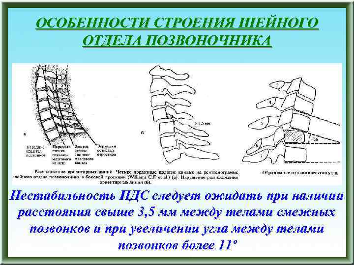 ОСОБЕННОСТИ СТРОЕНИЯ ШЕЙНОГО ОТДЕЛА ПОЗВОНОЧНИКА Нестабильность ПДС следует ожидать при наличии расстояния свыше 3,