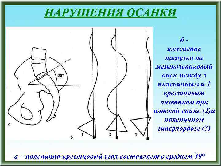 НАРУШЕНИЯ ОСАНКИ бизменение нагрузки на межпозвонковый диск между 5 поясничным и 1 крестцовым позвонком