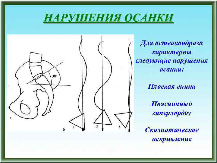 НАРУШЕНИЯ ОСАНКИ Для остеохондроза характерны следующие нарушения осанки: Плоская спина Поясничный гиперлордоз Сколиотическое искривление