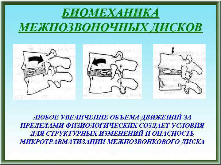 БИОМЕХАНИКА МЕЖПОЗВОНОЧНЫХ ДИСКОВ ЛЮБОЕ УВЕЛИЧЕНИЕ ОБЪЕМА ДВИЖЕНИЙ ЗА ПРЕДЕЛАМИ ФИЗИОЛОГИЧЕСКИХ СОЗДАЕТ УСЛОВИЯ ДЛЯ СТРУКТУРНЫХ