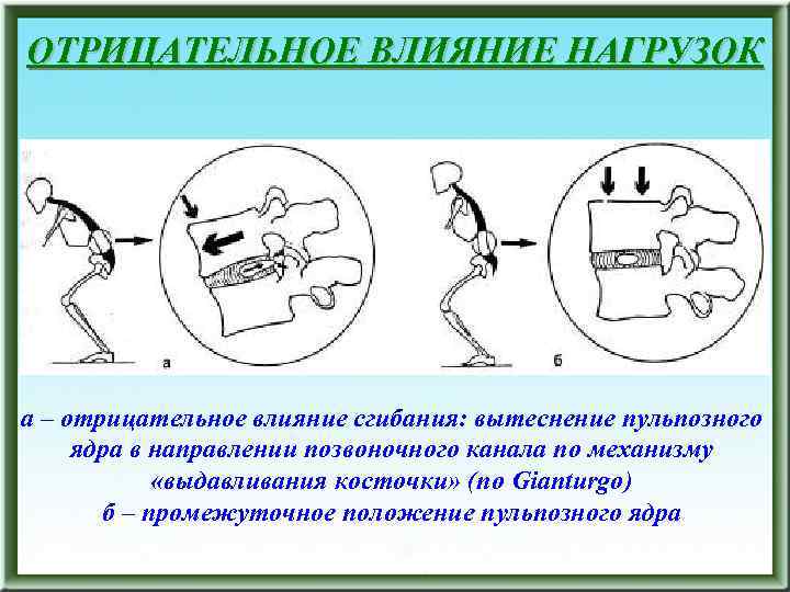 ОТРИЦАТЕЛЬНОЕ ВЛИЯНИЕ НАГРУЗОК а – отрицательное влияние сгибания: вытеснение пульпозного ядра в направлении позвоночного