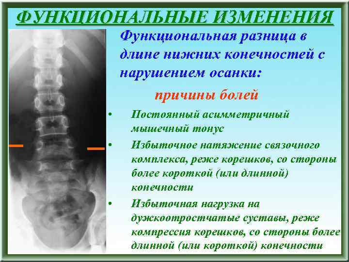 ФУНКЦИОНАЛЬНЫЕ ИЗМЕНЕНИЯ Функциональная разница в длине нижних конечностей с нарушением осанки: причины болей •