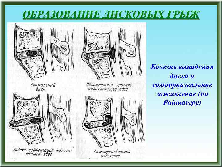 ОБРАЗОВАНИЕ ДИСКОВЫХ ГРЫЖ Болезнь выпадения диска и самопроизвольное заживление (по Райшауеру) 