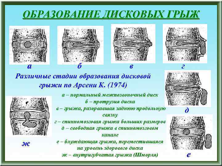 ОБРАЗОВАНИЕ ДИСКОВЫХ ГРЫЖ а б в г Различные стадии образования дисковой грыжи по Арсени