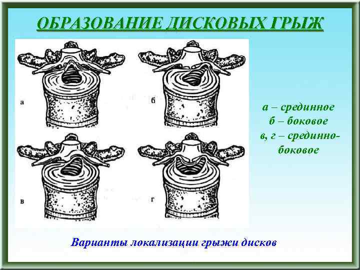 ОБРАЗОВАНИЕ ДИСКОВЫХ ГРЫЖ а – срединное б – боковое в, г – срединнобоковое Варианты