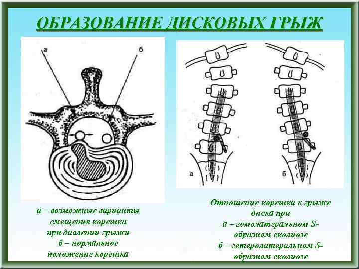 ОБРАЗОВАНИЕ ДИСКОВЫХ ГРЫЖ а – возможные варианты смещения корешка при давлении грыжи б –