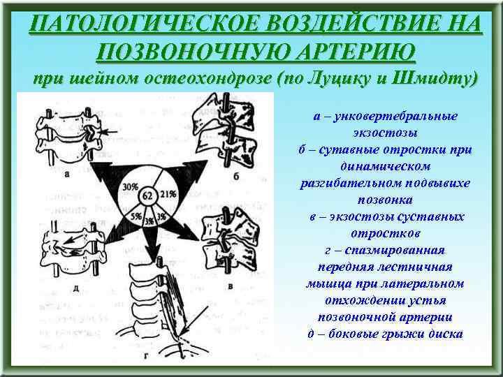 ПАТОЛОГИЧЕСКОЕ ВОЗДЕЙСТВИЕ НА ПОЗВОНОЧНУЮ АРТЕРИЮ при шейном остеохондрозе (по Луцику и Шмидту) а –