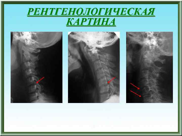 РЕНТГЕНОЛОГИЧЕСКАЯ КАРТИНА 