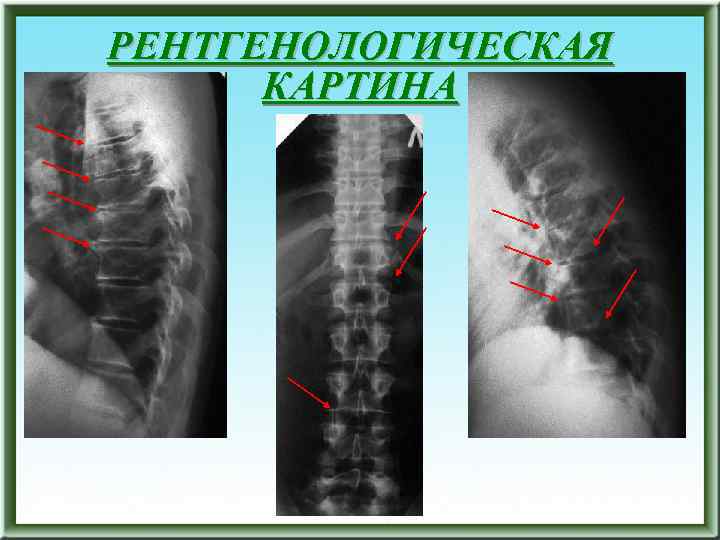 РЕНТГЕНОЛОГИЧЕСКАЯ КАРТИНА 