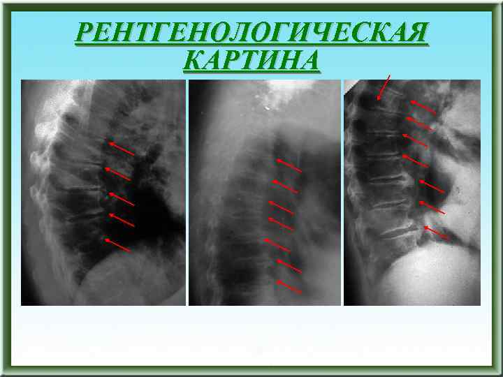 РЕНТГЕНОЛОГИЧЕСКАЯ КАРТИНА 