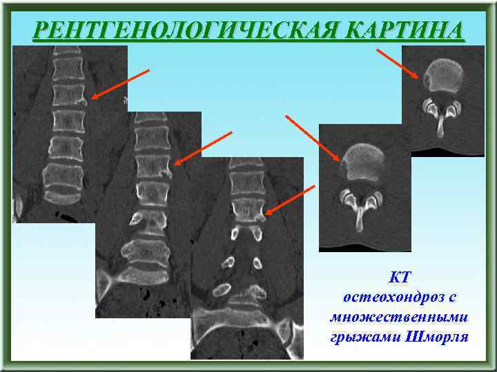 РЕНТГЕНОЛОГИЧЕСКАЯ КАРТИНА КТ остеохондроз с множественными грыжами Шморля 