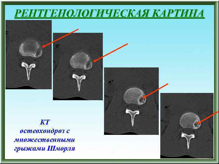 РЕНТГЕНОЛОГИЧЕСКАЯ КАРТИНА КТ остеохондроз с множественными грыжами Шморля 