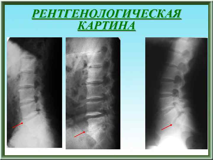 РЕНТГЕНОЛОГИЧЕСКАЯ КАРТИНА 