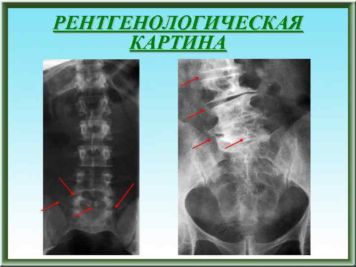 РЕНТГЕНОЛОГИЧЕСКАЯ КАРТИНА 