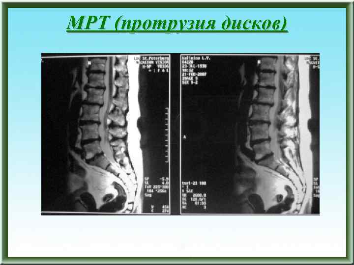 МРТ (протрузия дисков) 