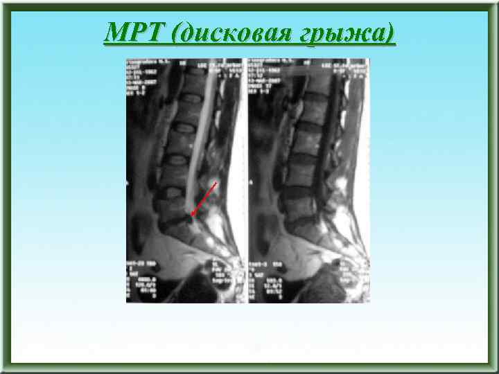 МРТ (дисковая грыжа) 