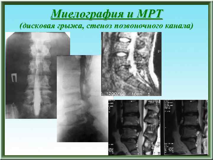 Миелография и МРТ (дисковая грыжа, стеноз позвоночного канала) 