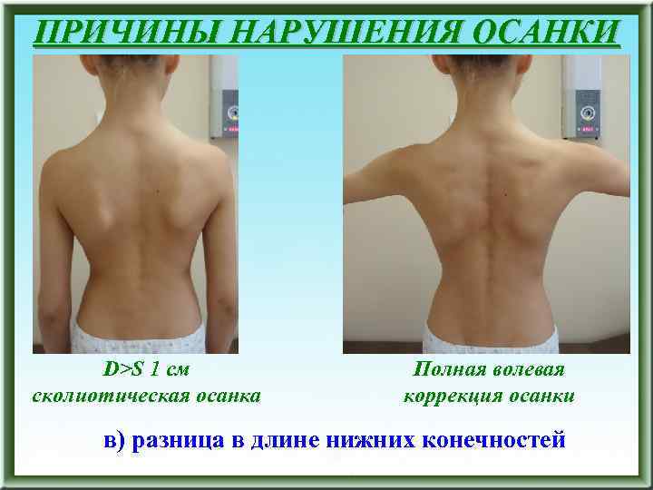 ПРИЧИНЫ НАРУШЕНИЯ ОСАНКИ D>S 1 см сколиотическая осанка Полная волевая коррекция осанки в) разница