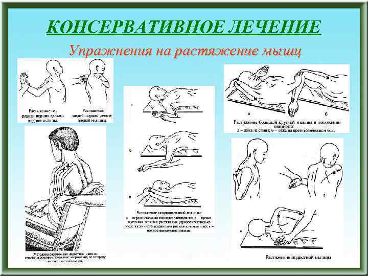 КОНСЕРВАТИВНОЕ ЛЕЧЕНИЕ Упражнения на растяжение мышц 