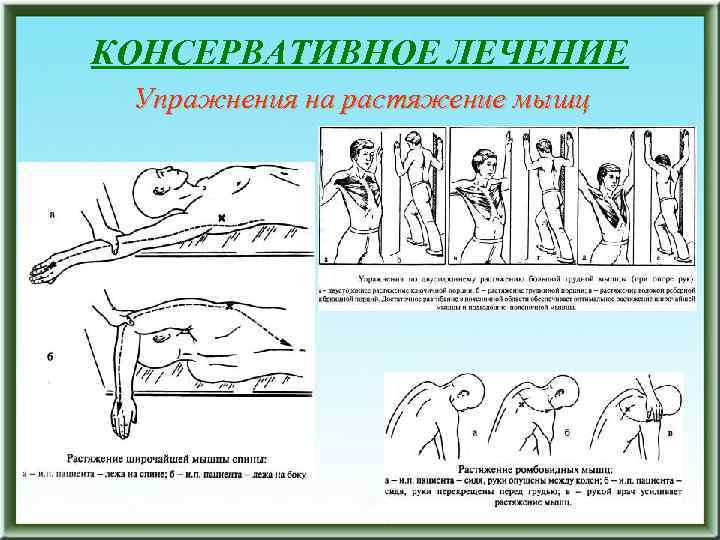 КОНСЕРВАТИВНОЕ ЛЕЧЕНИЕ Упражнения на растяжение мышц 