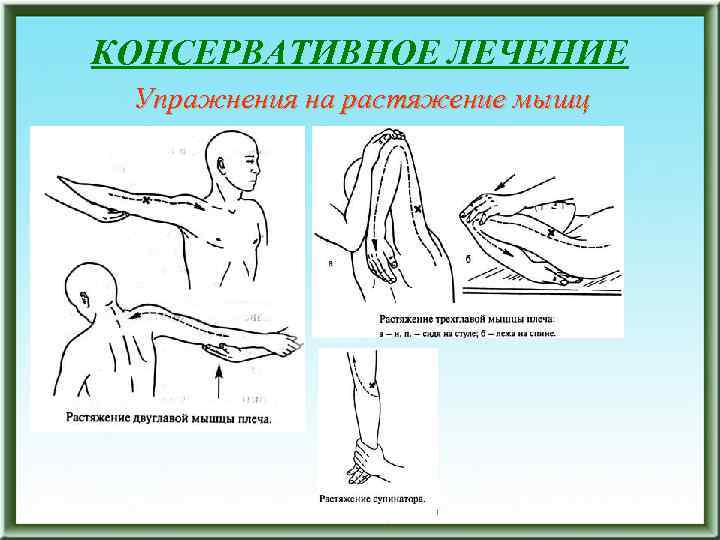 КОНСЕРВАТИВНОЕ ЛЕЧЕНИЕ Упражнения на растяжение мышц 