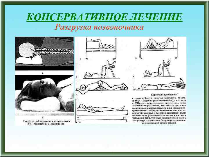 КОНСЕРВАТИВНОЕ ЛЕЧЕНИЕ Разгрузка позвоночника 