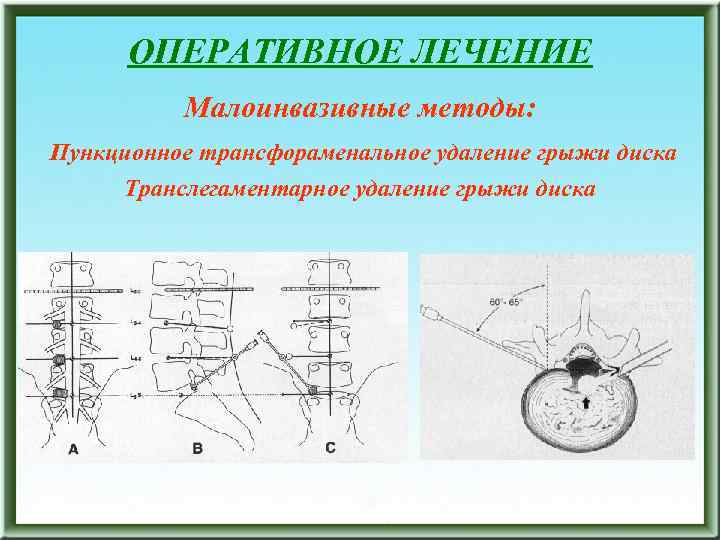 ОПЕРАТИВНОЕ ЛЕЧЕНИЕ Малоинвазивные методы: Пункционное трансфораменальное удаление грыжи диска Транслегаментарное удаление грыжи диска 