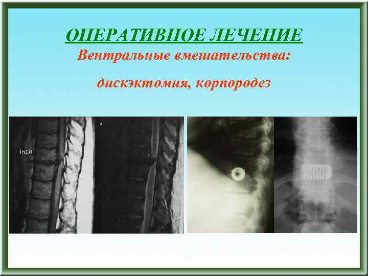 ОПЕРАТИВНОЕ ЛЕЧЕНИЕ Вентральные вмешательства: дискэктомия, корпородез 