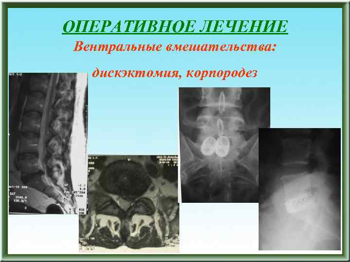 ОПЕРАТИВНОЕ ЛЕЧЕНИЕ Вентральные вмешательства: дискэктомия, корпородез 