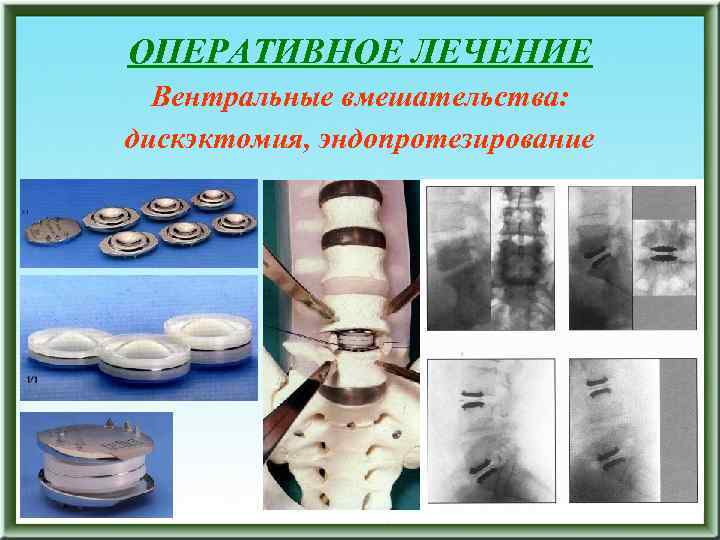 ОПЕРАТИВНОЕ ЛЕЧЕНИЕ Вентральные вмешательства: дискэктомия, эндопротезирование 