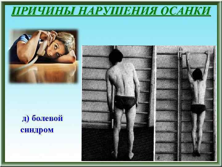 ПРИЧИНЫ НАРУШЕНИЯ ОСАНКИ д) болевой синдром 