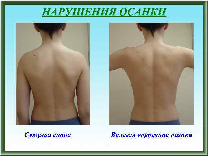 НАРУШЕНИЯ ОСАНКИ Сутулая спина Волевая коррекция осанки 
