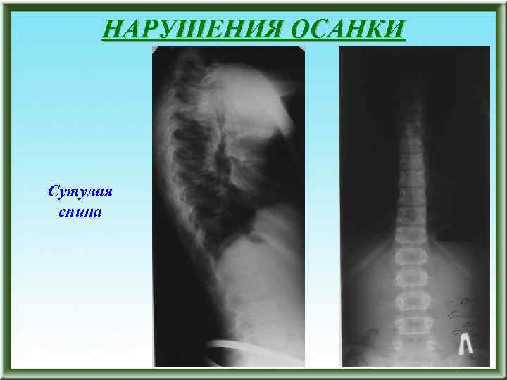 НАРУШЕНИЯ ОСАНКИ Сутулая спина 
