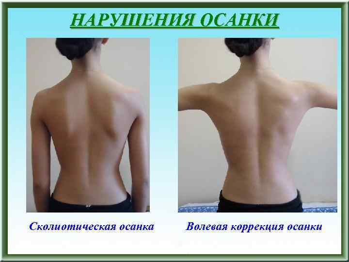 НАРУШЕНИЯ ОСАНКИ Сколиотическая осанка Волевая коррекция осанки 