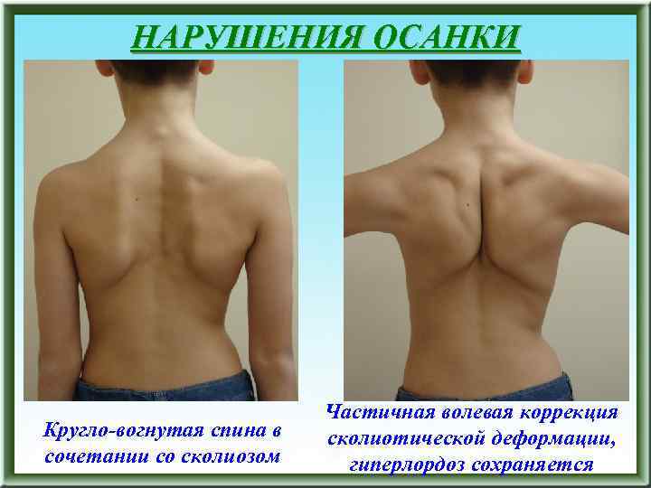 НАРУШЕНИЯ ОСАНКИ Кругло-вогнутая спина в сочетании со сколиозом Частичная волевая коррекция сколиотической деформации, гиперлордоз