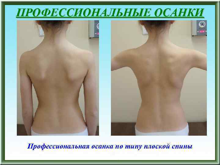 ПРОФЕССИОНАЛЬНЫЕ ОСАНКИ Профессиональная осанка по типу плоской спины 