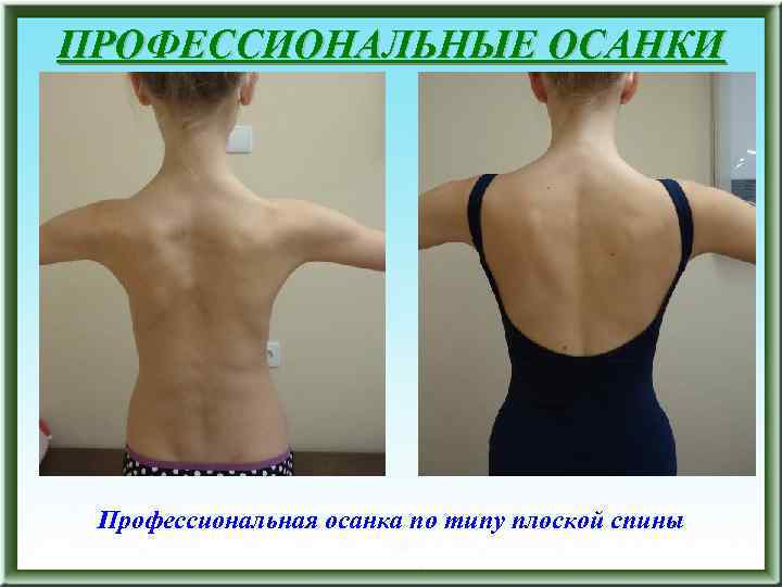ПРОФЕССИОНАЛЬНЫЕ ОСАНКИ Профессиональная осанка по типу плоской спины 