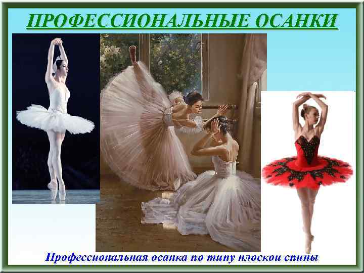 ПРОФЕССИОНАЛЬНЫЕ ОСАНКИ Профессиональная осанка по типу плоской спины 